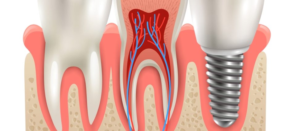 Dental implant and real tooth anatomy closeup cut away section model side view realistic vector illustration